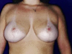 Breast Lift: after surgery