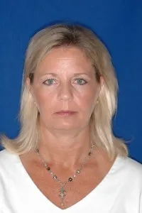 Eyelid Tuck: before surgery