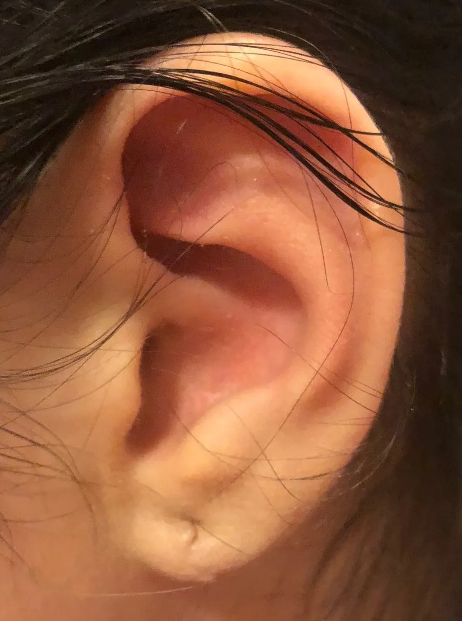Reconstructive case, after surgery